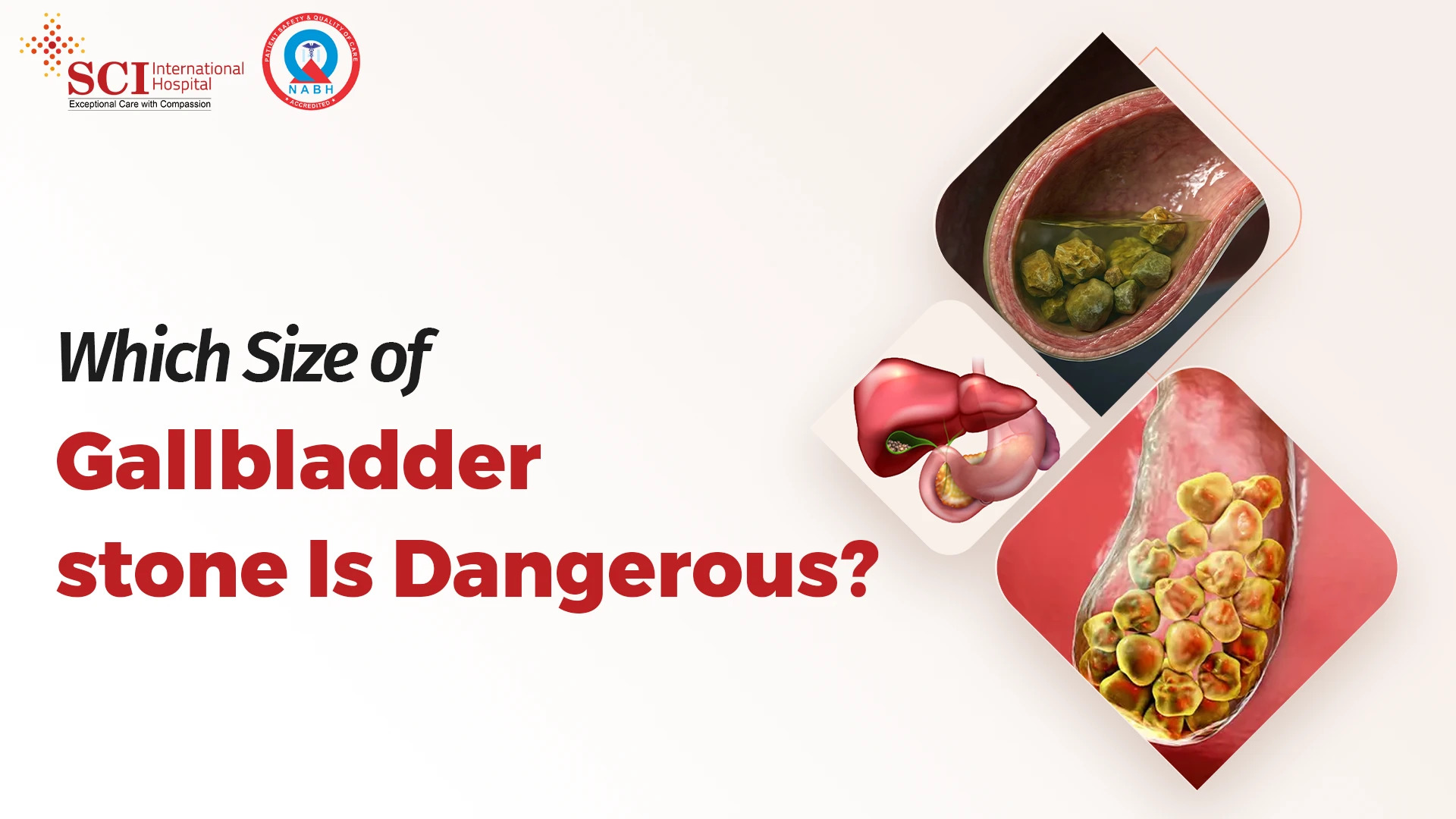 Which Size of Gallbladder Stone Is Dangerous?