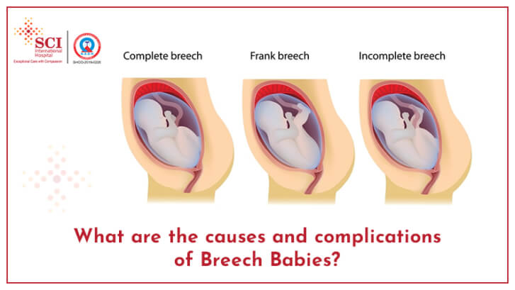Breech Babies: Causes and Complications Which You Must Know