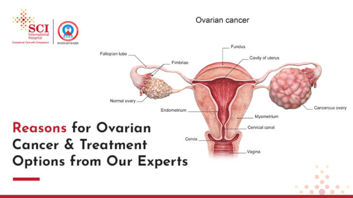 10 Reasons for Ovarian Cancer and Treatment Options from Our Experts
